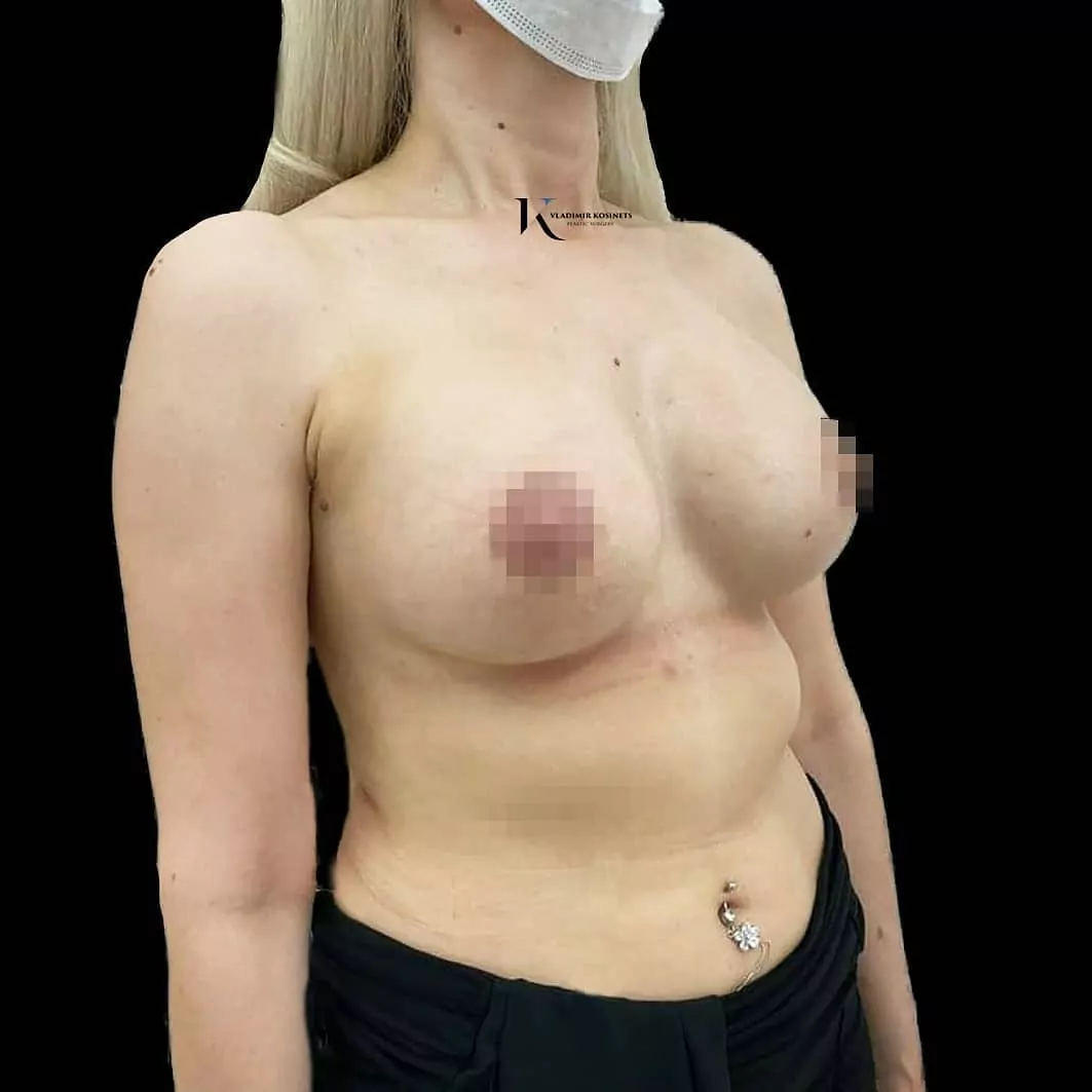хирургическая подтяжка груди