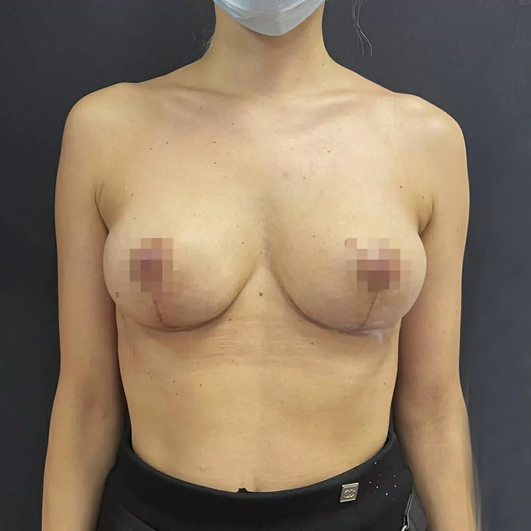 Т-образная подтяжка груди