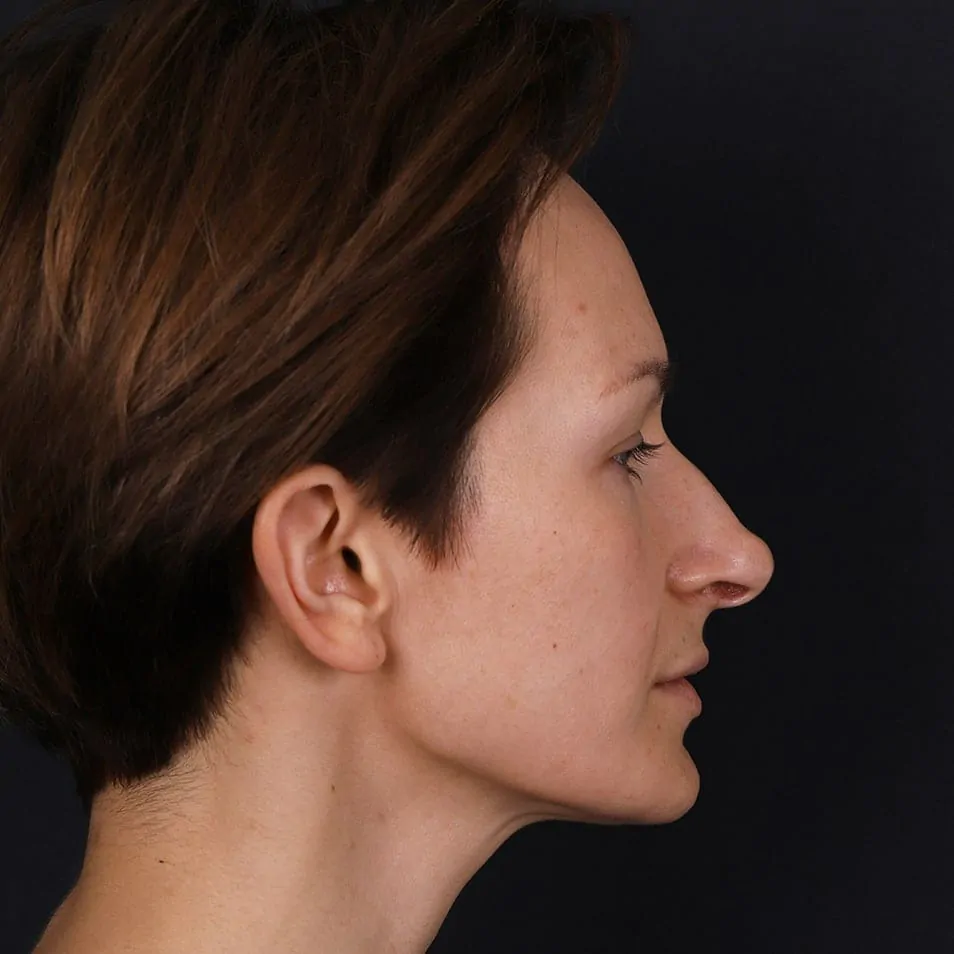 ринопластика кончика носа